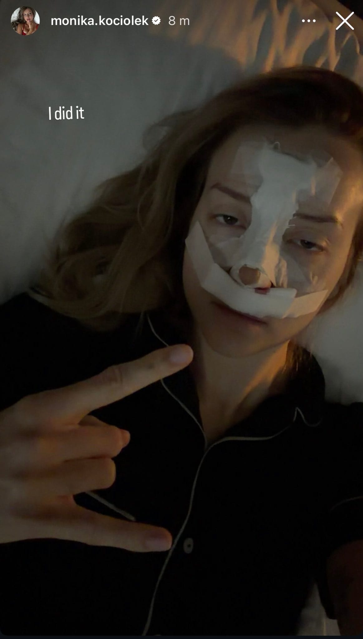 Monika Kociołek zrobiła operację nosa! Influencerka pokazała efekty na InstaStory 2 Monika Kociołek rhinoplastyka
Monika Kociołek pokazała zdjęcie po operacji
Monika Kociołek Instagram operacja nosa